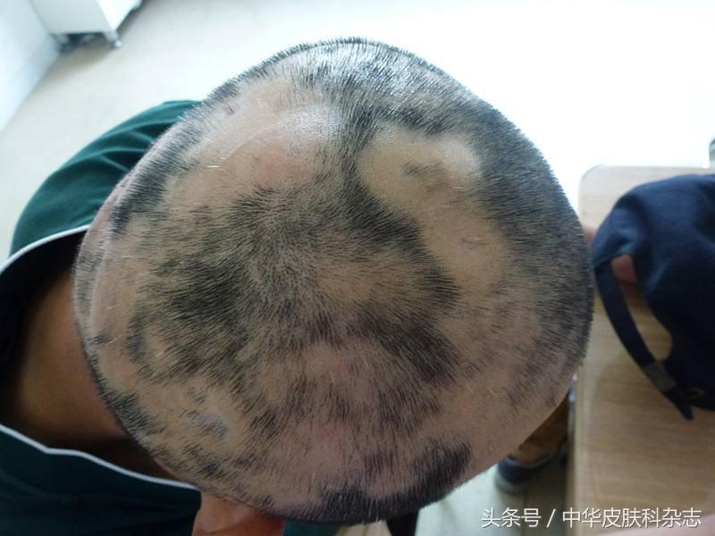 19岁男子脱发严重，竟查出梅毒，一场青春的警钟