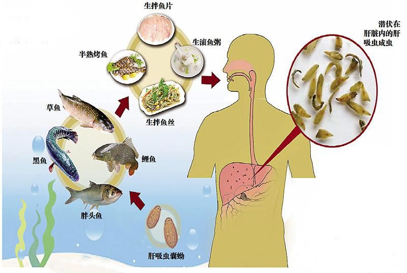 中山男子取结石经历，肝吸虫的意外发现与健康警醒